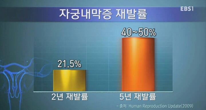 자궁내막조직이 자궁밖에 존재하는 자궁내막증.jpg | 인스티즈