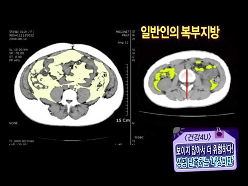 침묵의 암살자 뱃속의 시한폭탄 내장지방의 위험성 | 인스티즈