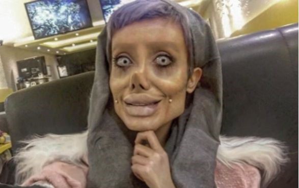 안제리나 졸리 따라 성형한 이란여자 (혐오주의) | 인스티즈